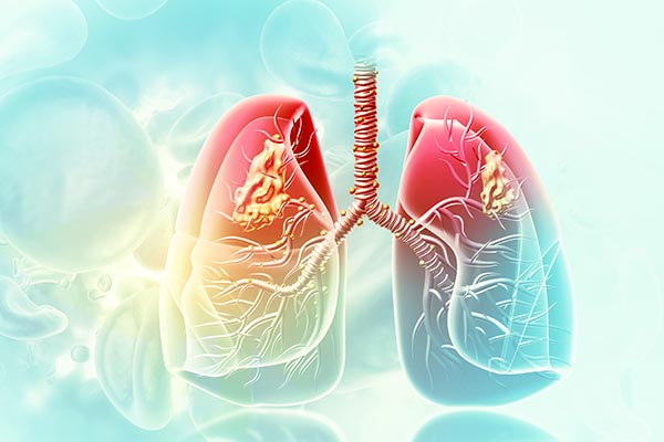 lung cancer illustration