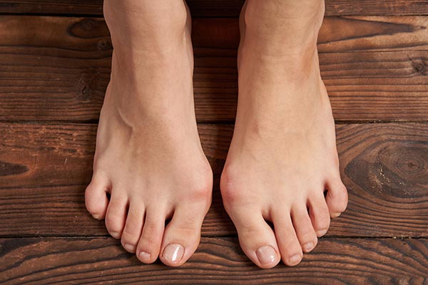woman with bunions