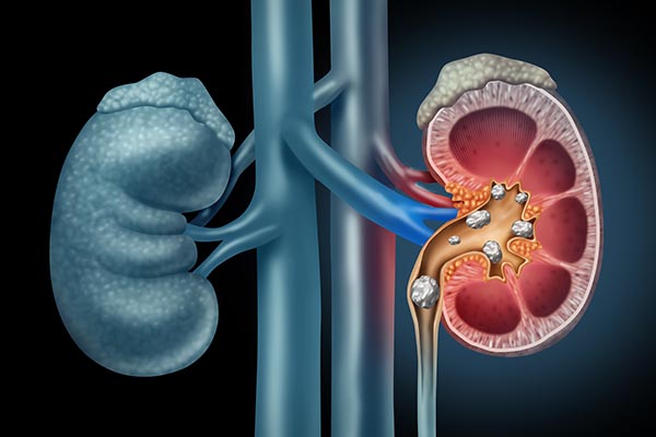 kidney stones