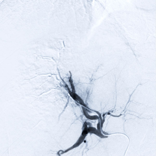 Interventional Radiology