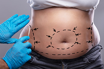 A surgeon marking a woman's stomach with a marker